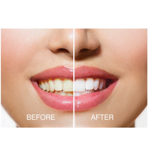 Rio Rio Smile White Advanced Teeth Whitening Kit Liquidazione
