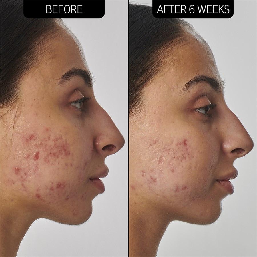 The INKEY List Sieri SuperSolutions 1% Retinol Serum Affare Del Giorno